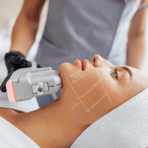 hifu hifu facial hifu oradea