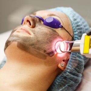 carbon peel oradea