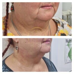 rezultate hifu facial oradea inainte dupa gusa barbie dubla arborada medical