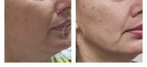 hifu facial oradea rezultate inainte dupa contur mandibular oval fata arborada medical