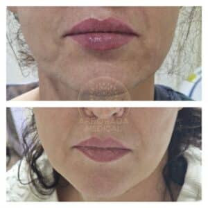 lifting facial hifu oradea rezultate inainte dupa piele lasata arborada medical