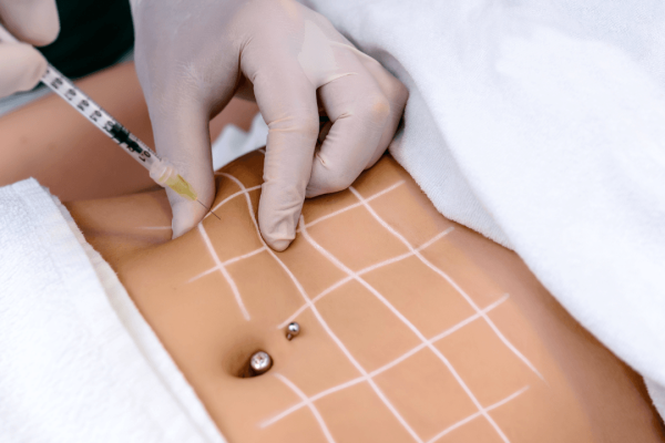 lipoliza injectabila
