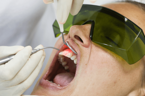 tratament laser dentar