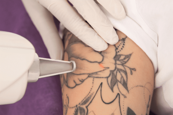 indepartare tatuaj oradea