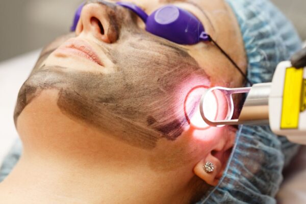 carbon peel oradea